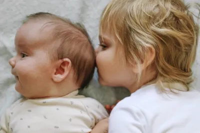 Patient picture before craniosynostosis treatment 