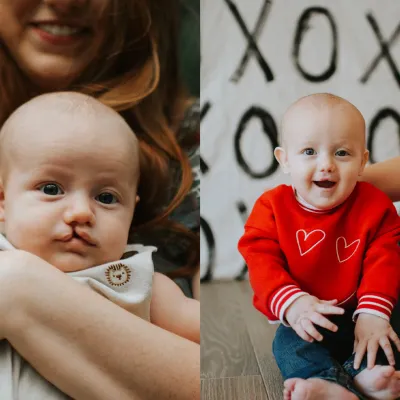 Henry before and after cleft lip surgery