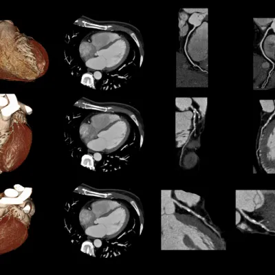 mapping-cardiac-ct