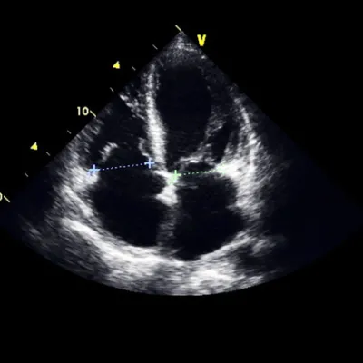 transesophageal-echocardiogram