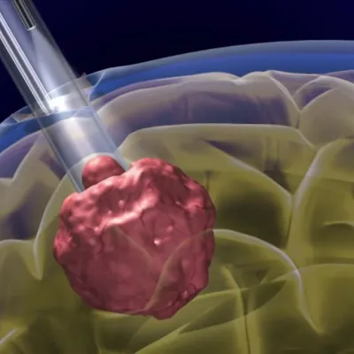Brain Port Surgery - Minimally Invasive Brain Surgery