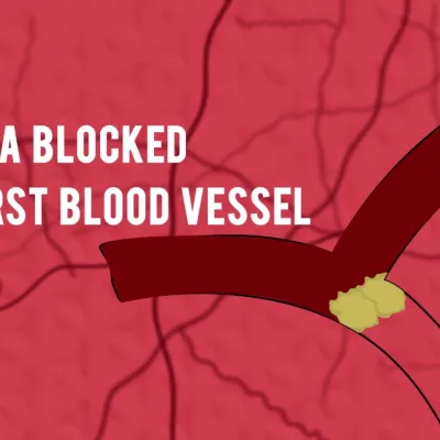 Think F.A.S.T. - Stroke signs and risk factors