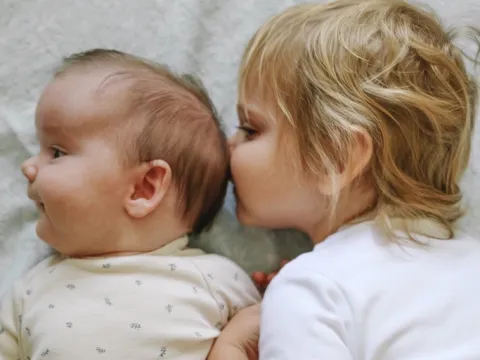 Patient picture before craniosynostosis treatment 