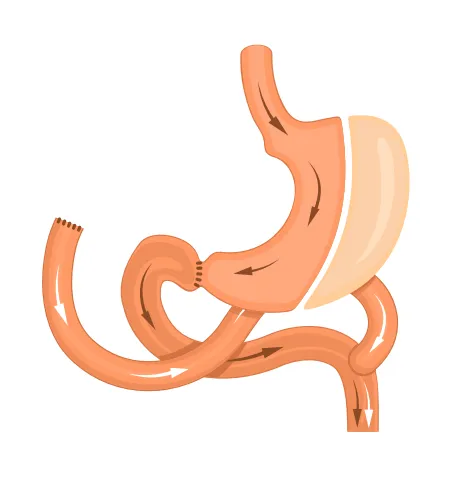Graphic of a duodenal switch