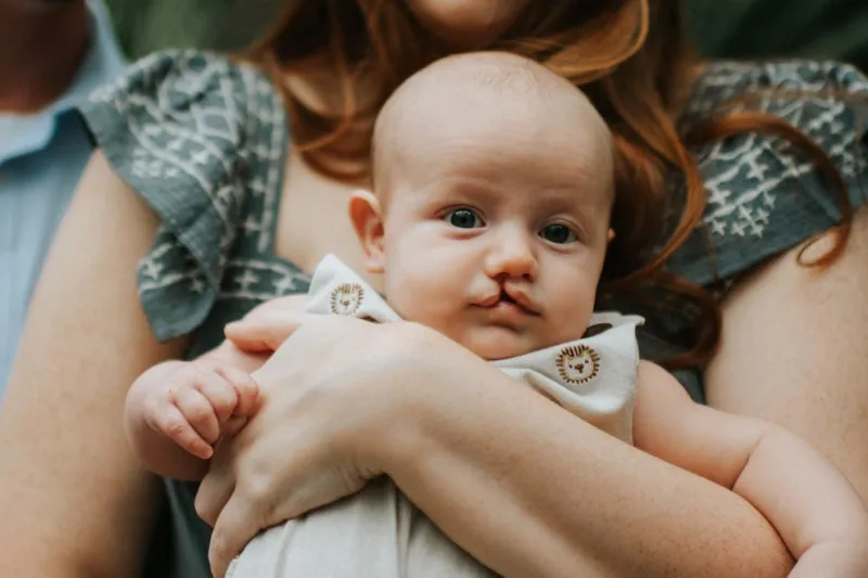 Henry before cleft lip surgery