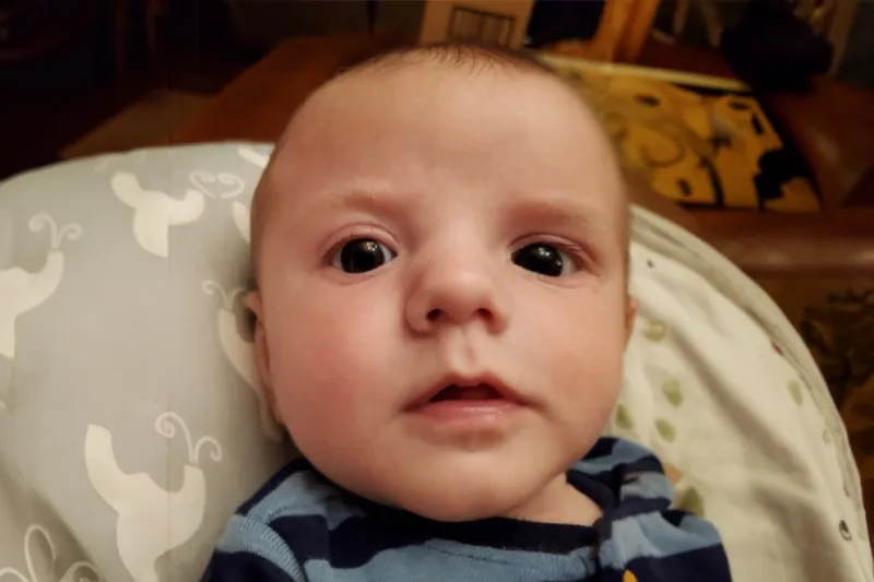 Mikey after Craniosynostosis Treatment