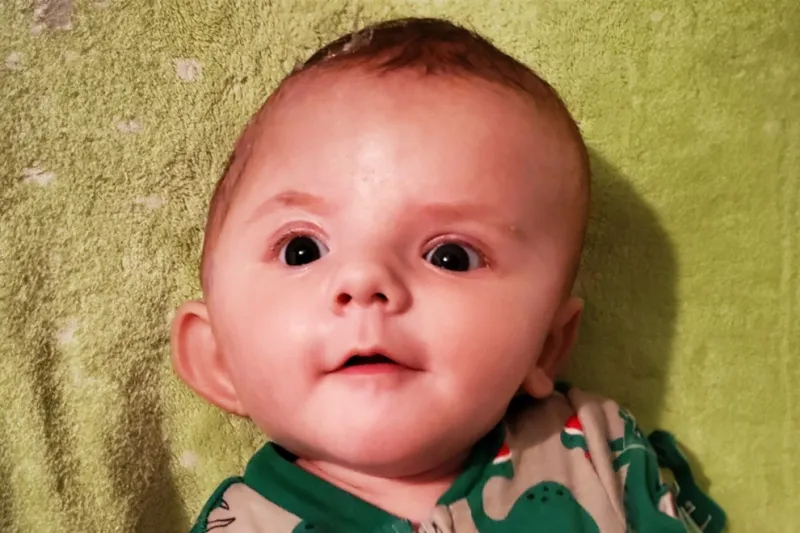 Mikey before Craniosynostosis Treatment 