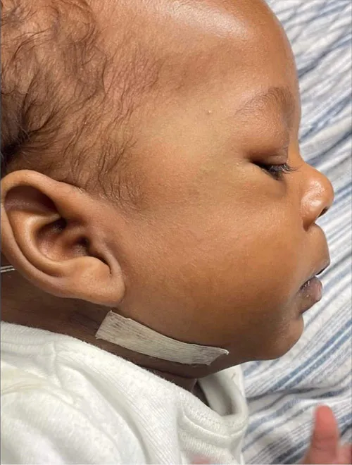 NaKyng after mandible distraction surgery