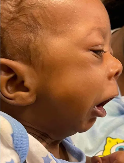 NaKyng Before mandible distraction surgery